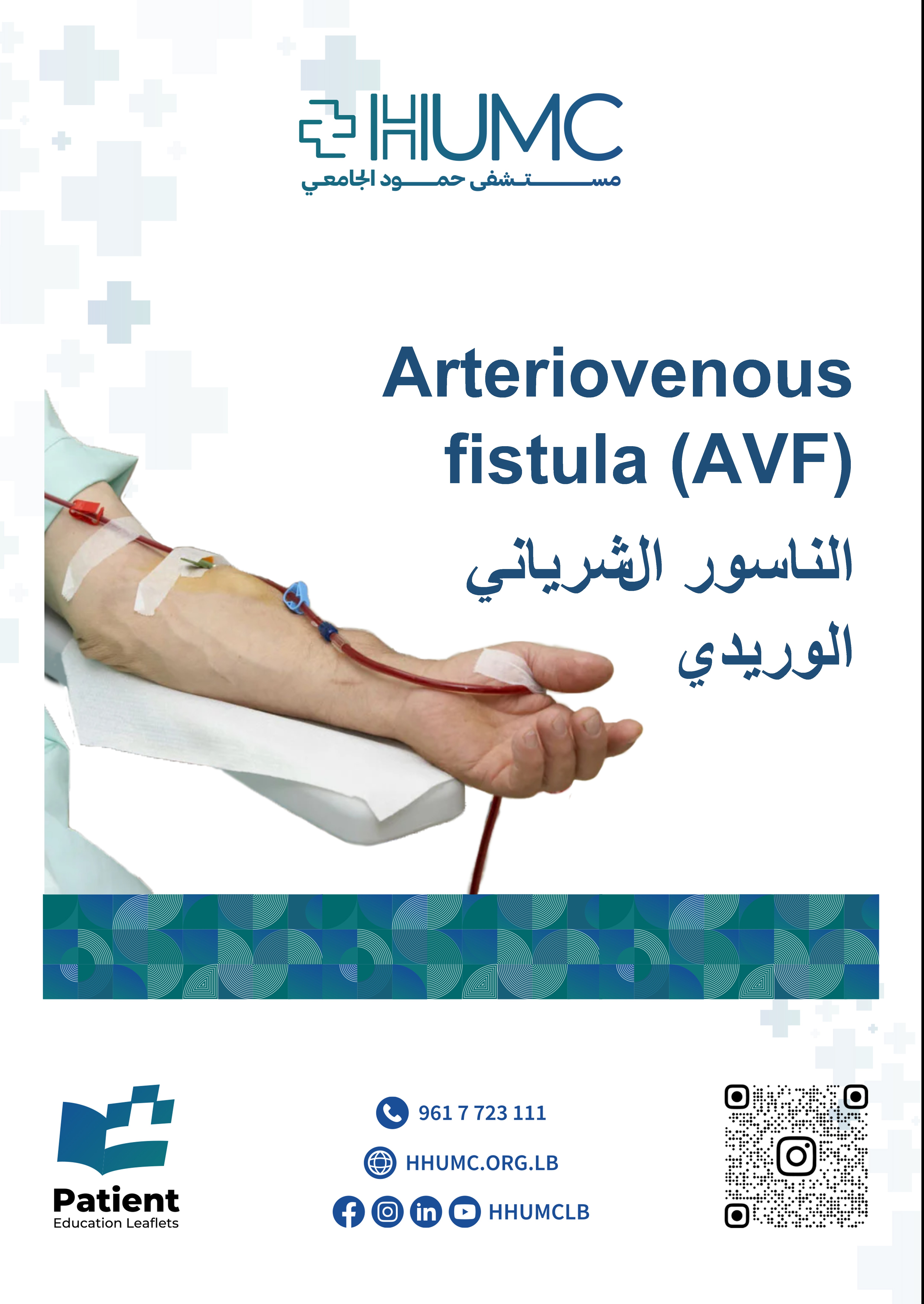 Arteriovenous fistula (AVF)